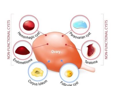 Ovarian Cyst