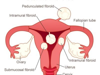 Uterian Fibroids