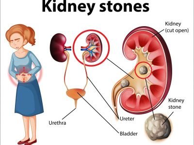 kidney-stones